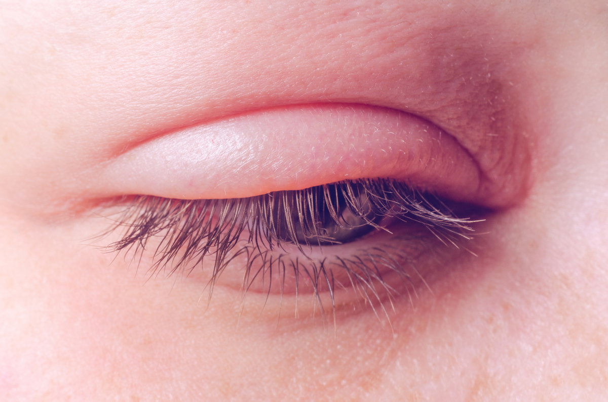 Weißer Hautkrebs am Auge? Nicht mit Gerstenkorn verwechseln