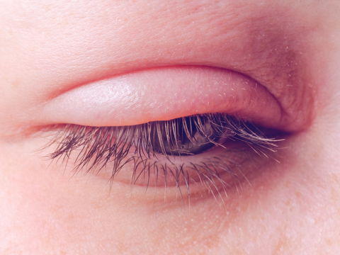 Weißer Hautkrebs am Auge? Nicht mit Gerstenkorn verwechseln