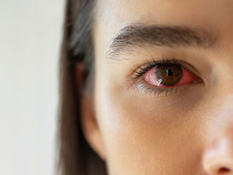Rote Augen: Was steckt dahinter und welche Tipps helfen?