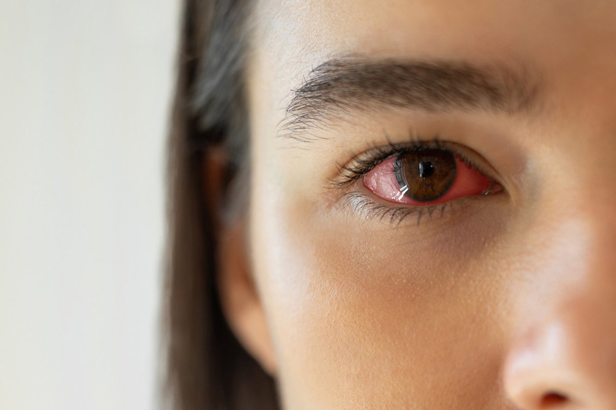 rotes Auge