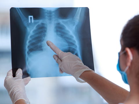 Silikose: Ursachen, Symptome, Behandlung und Lebenserwartung