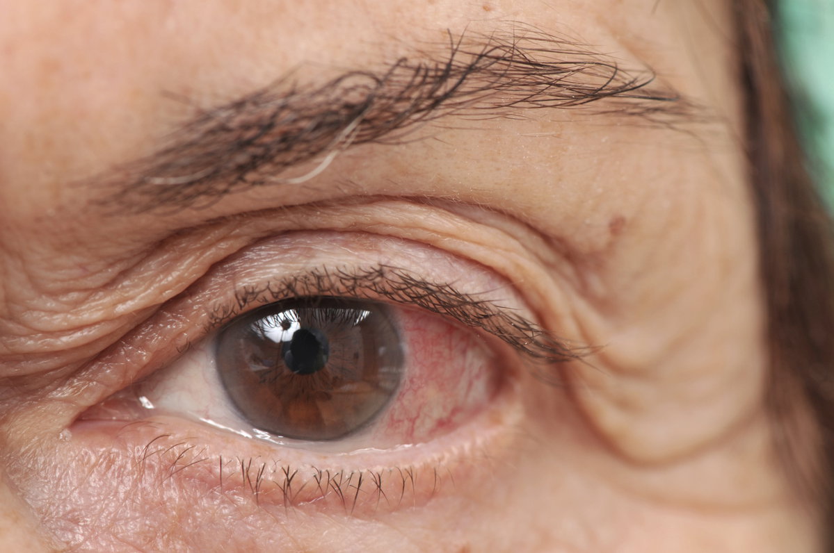 Auge eines älteren Mannes mit Bindehautentzündung zeigt Symptome wie Rötungen und Schwellungen