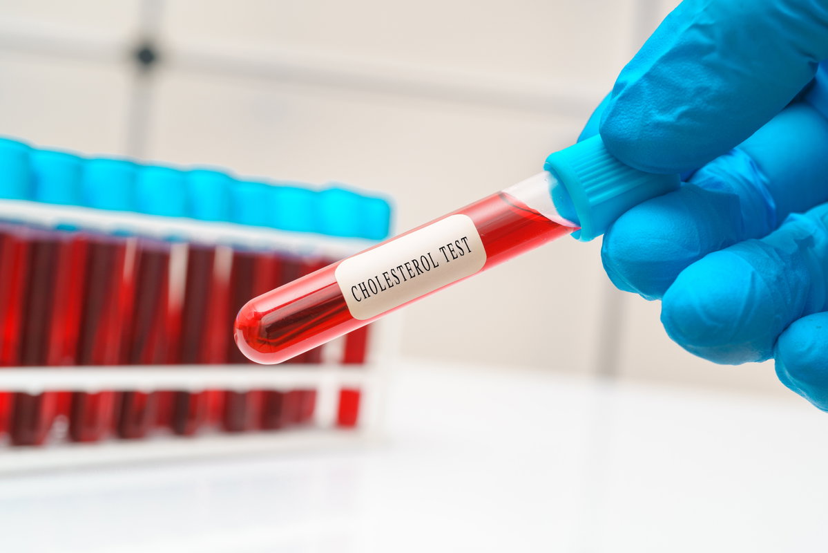 Blutprobe eines Cholesterin Tests