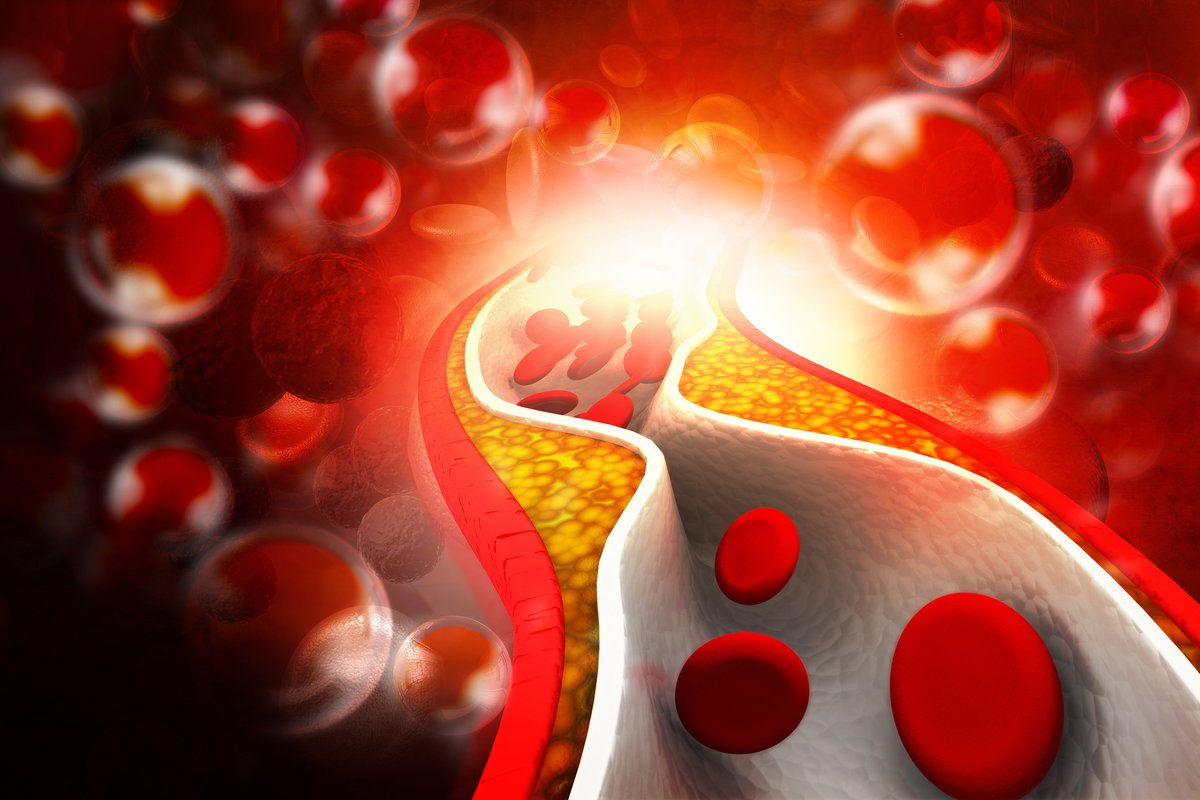 Verkalkte Arterie