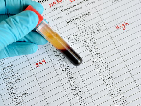 HDL-Cholesterin zu hoch: Risiko für Demenzerkrankungen steigt