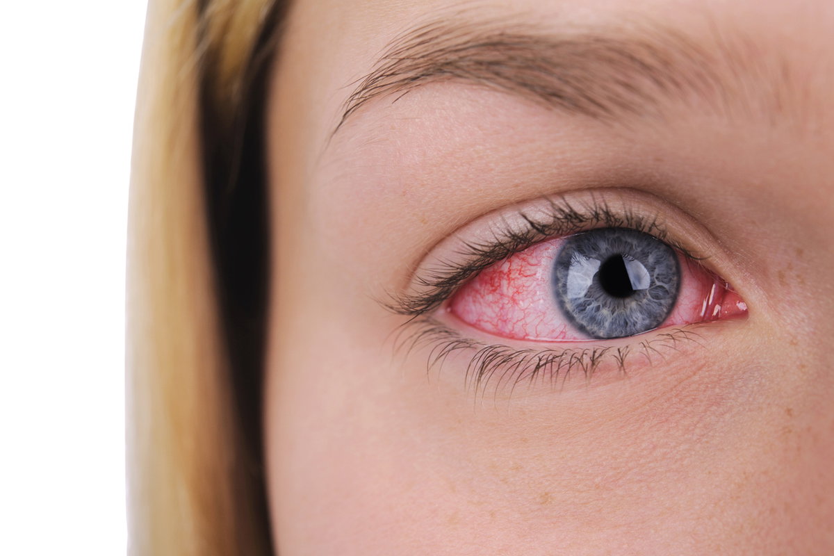 Thrombose im Auge