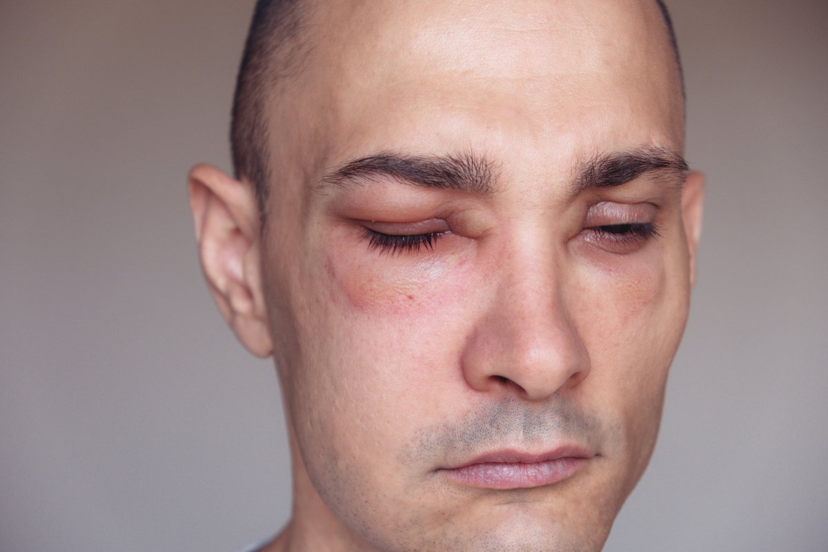 Mann mit allergischen Schwellungen (Angioödem) im Gesicht