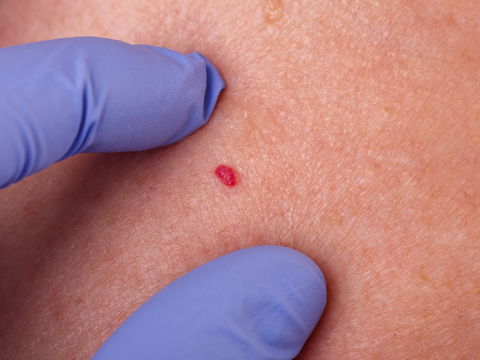 Blutschwämmchen bei Erwachsenen: Woher sie plötzlich kommen