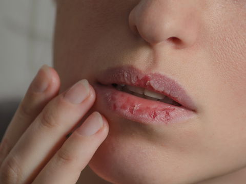 Lippenkrebs: Symptome, Ursachen, Behandlung