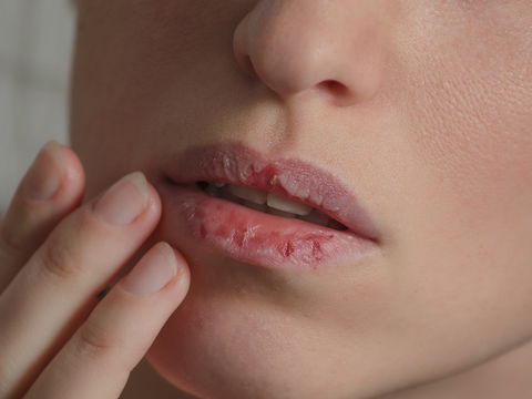 Lippenkrebs: Symptome, Ursachen, Behandlung