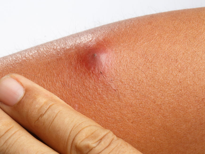 Ein Abszess auf einem Arm