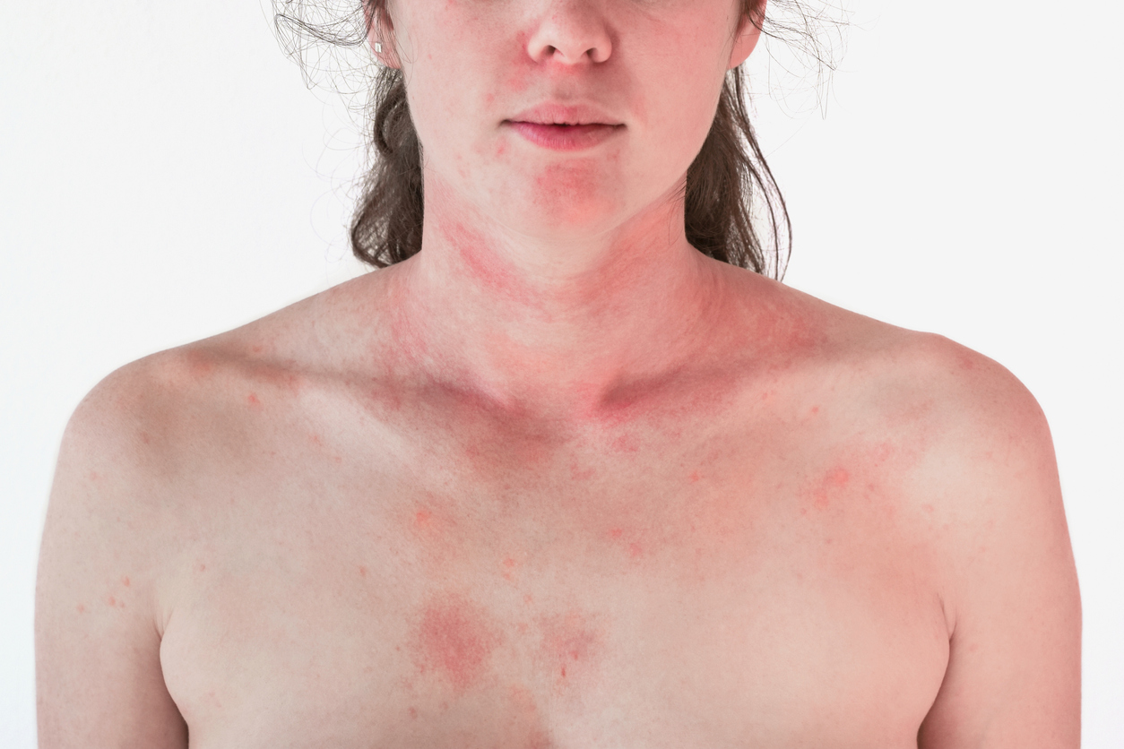 Dermatomyositis: Daran erkennen Sie die schlimme Haut-Muskel-Krankheit