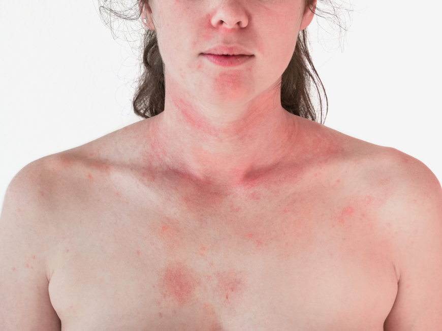 Dermatomyositis
