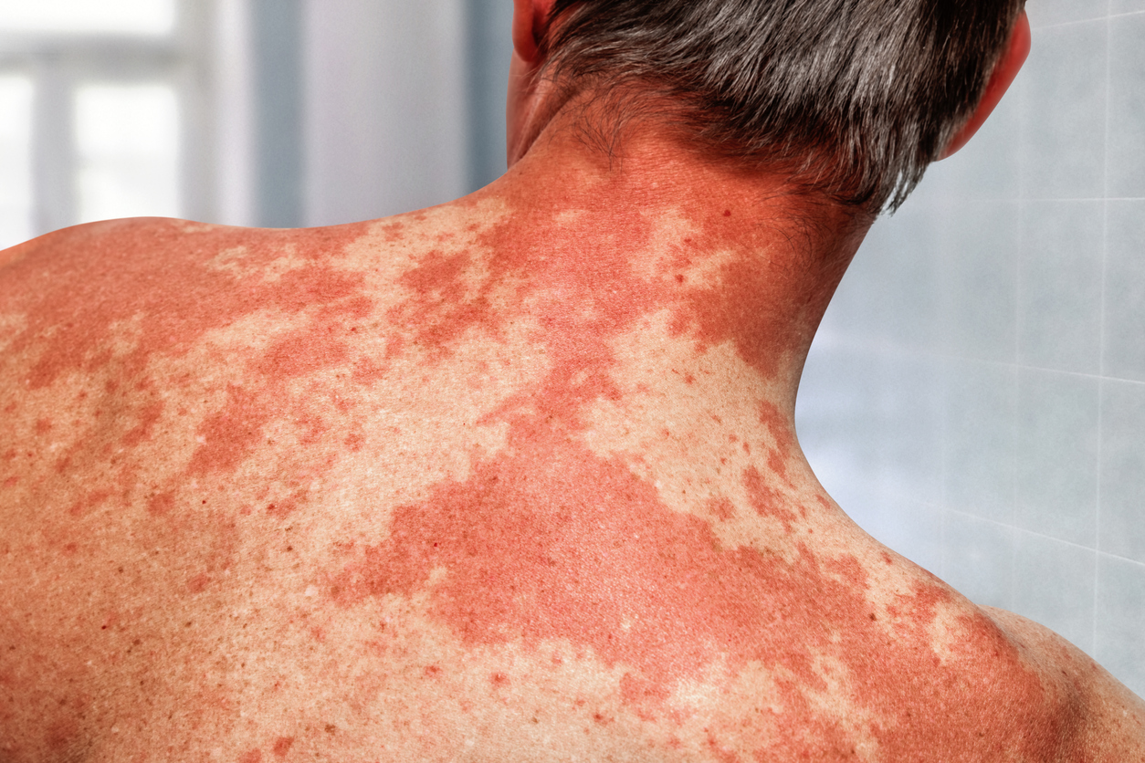 Feuermal: Ursachen, Diagnose und Behandlungsmöglichkeiten
