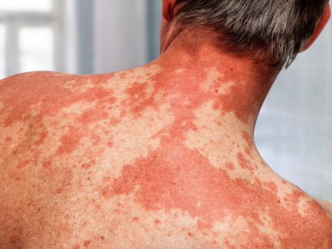 Feuermal: Ursachen, Diagnose und Behandlungsmöglichkeiten