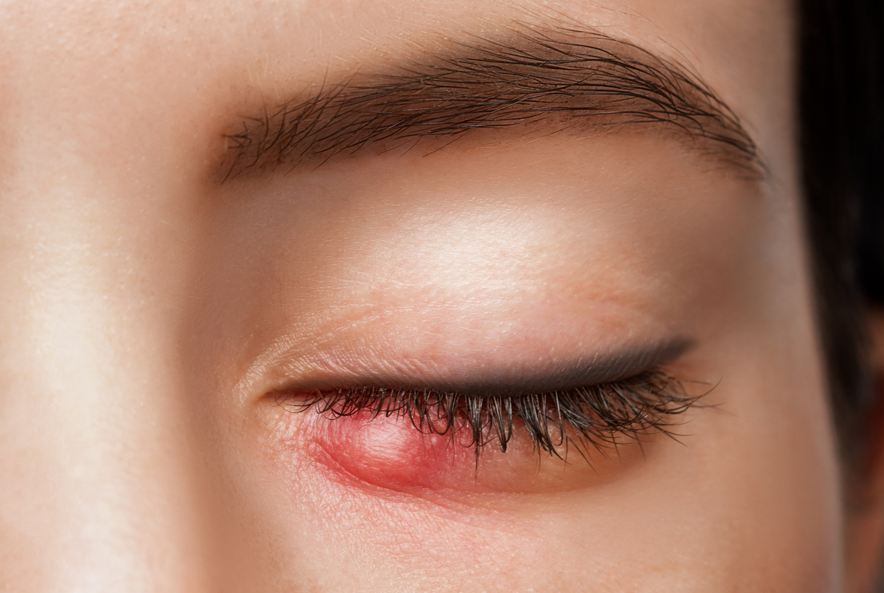 Hagelkorn im Auge: Von der harmlosen Beule zum schmerzhaften Problem 