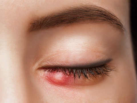 Hagelkorn im Auge: Von der harmlosen Beule zum schmerzhaften Problem
