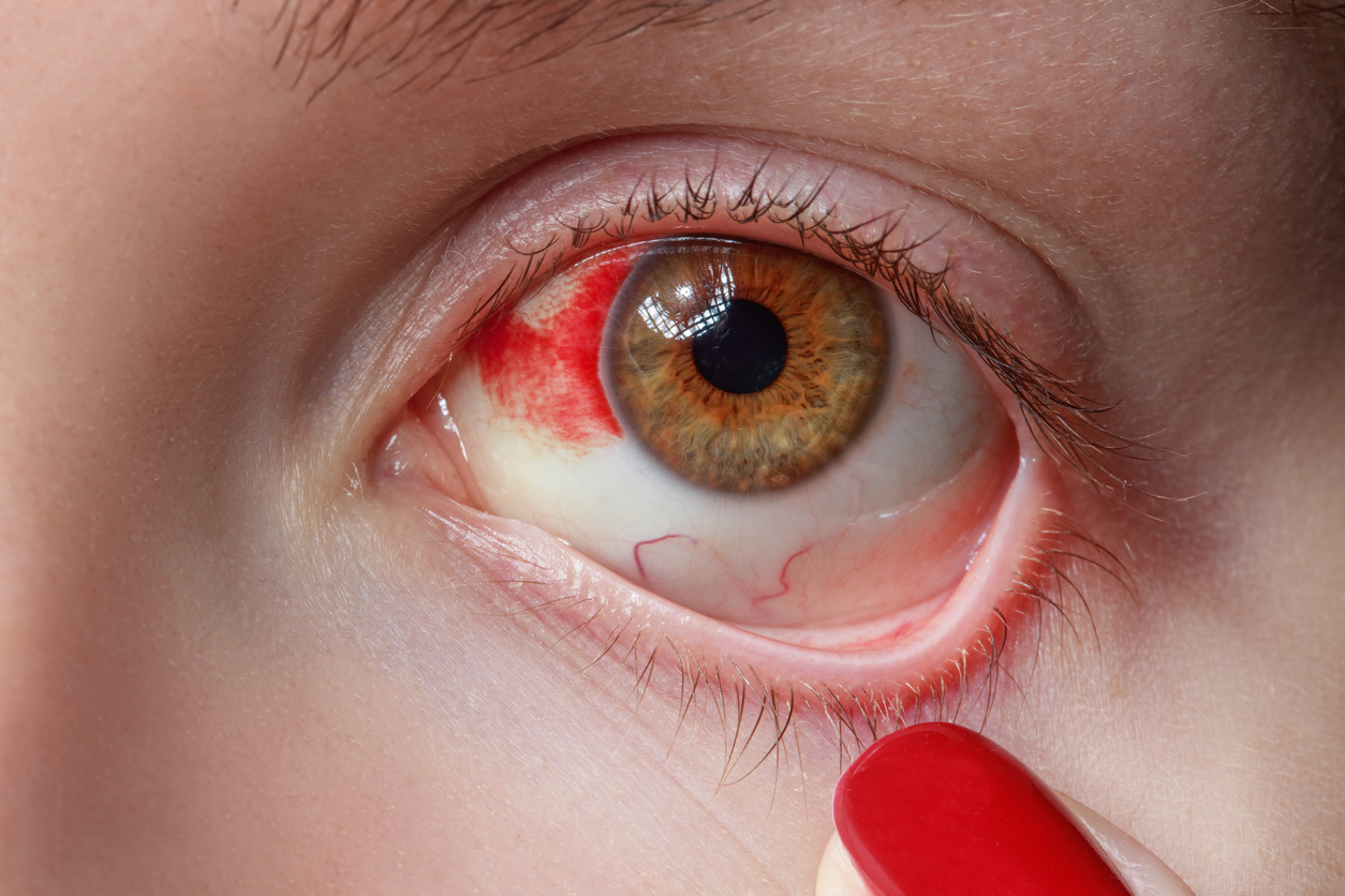 Achtung, Hornhautentzündung: So erkennen Sie eine Keratitis