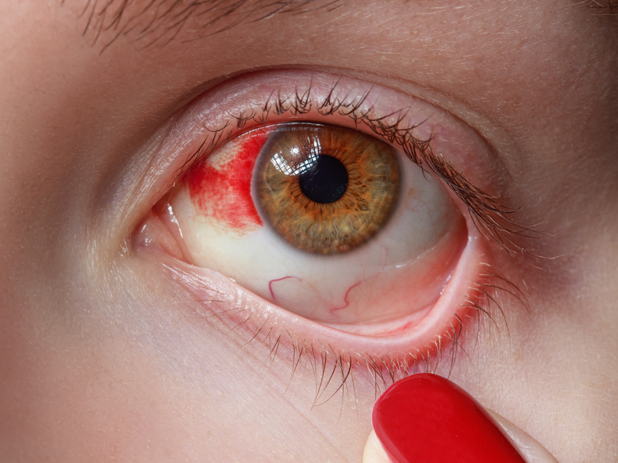 Rotes Auge einer Frau