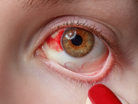 Achtung, Hornhautentzündung: So erkennen Sie eine Keratitis
