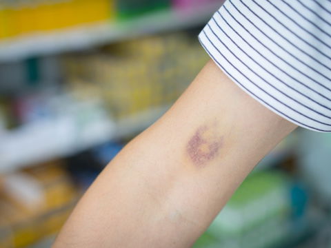 Omas Hausmittel gegen Blutergüsse: So helfen natürliche Wundermittel