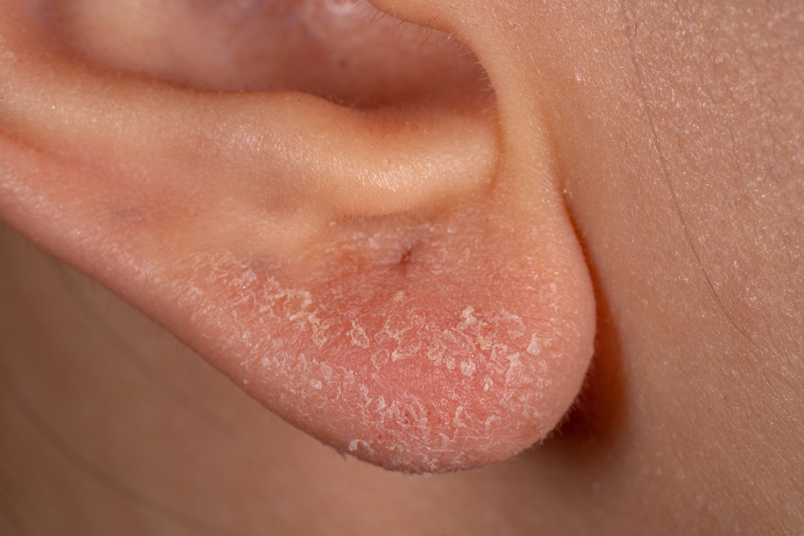 Allergie durch Ohrringe: Das sind die Anzeichen einer Nickelallergie