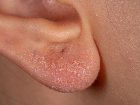 Allergie durch Ohrringe: Das sind die Anzeichen einer Nickelallergie
