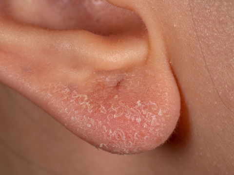 Allergie durch Ohrringe: Das sind die Anzeichen einer Nickelallergie