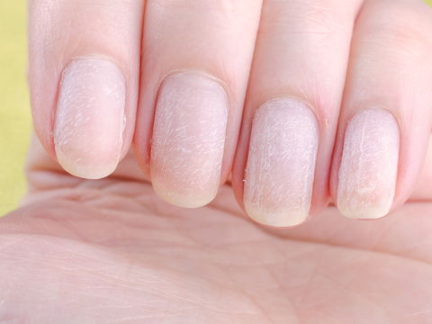 Gelbe Fingernägel: Was ist die Ursache und was kann helfen?