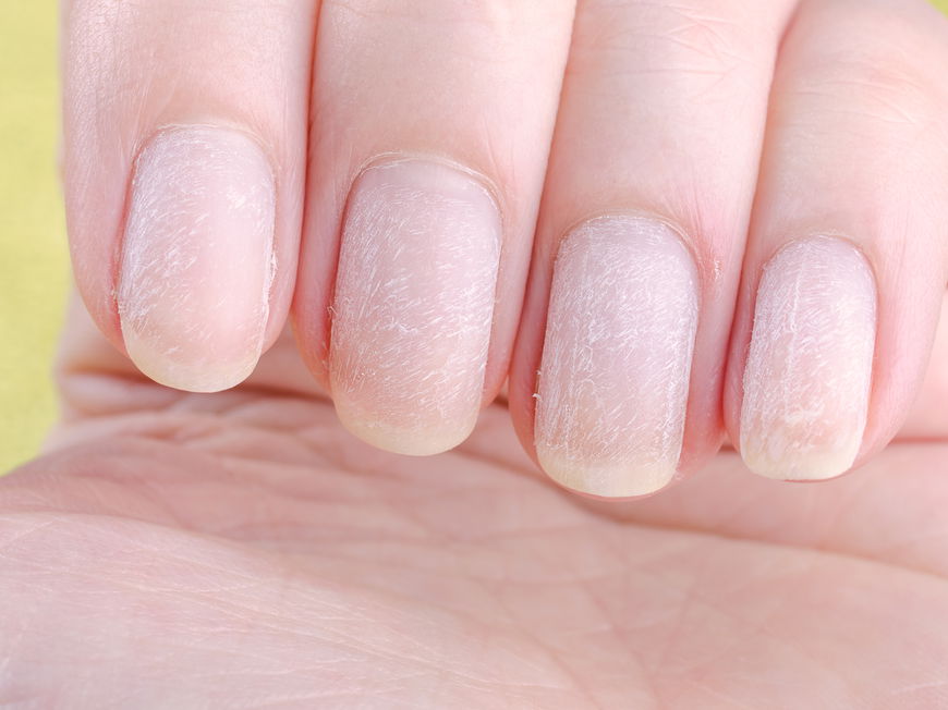 Gelbe und trockene Fingernägel