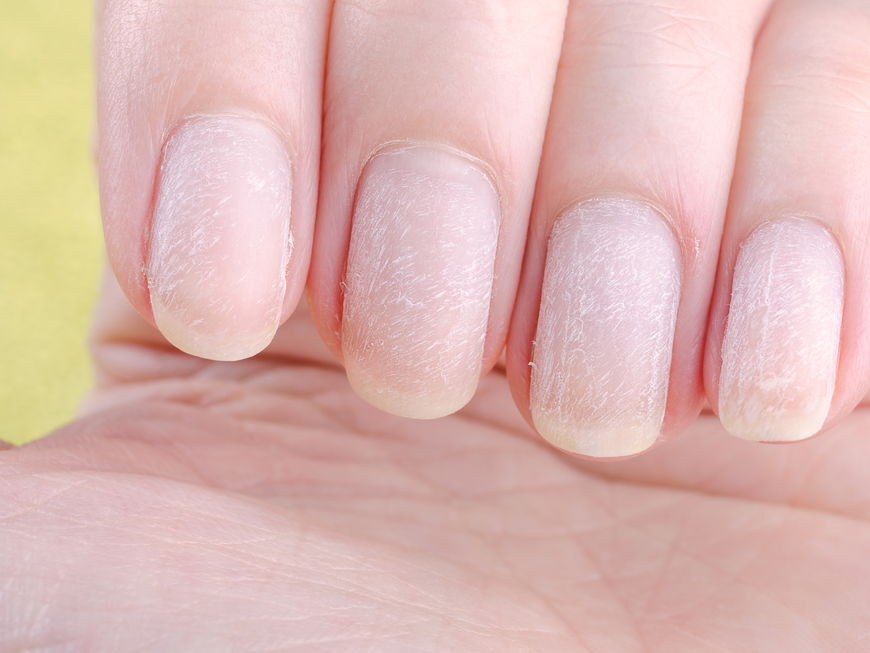 Gelbe und trockene Fingernägel