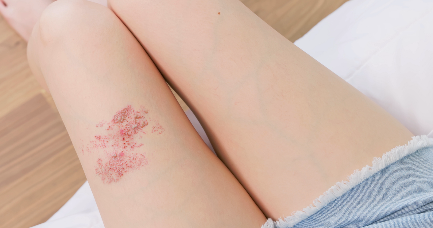 Gürtelrose-Hautausschlag: Wie Stress das Risiko der Erkrankung erhöht