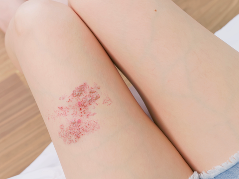 Gürtelrose-Hautausschlag: Wie Stress das Risiko der Erkrankung erhöht