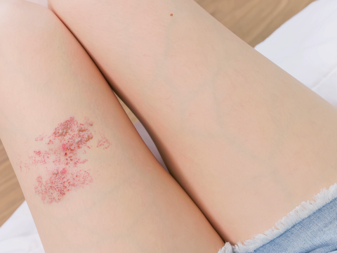 Gürtelrose-Hautausschlag: Wie Stress das Risiko der Erkrankung erhöht
