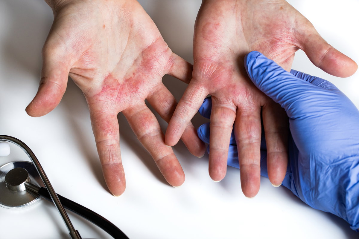 Eine Hand in Latexhandschuhen hält die Hände eines Patienten mit allergischem Ausschlag