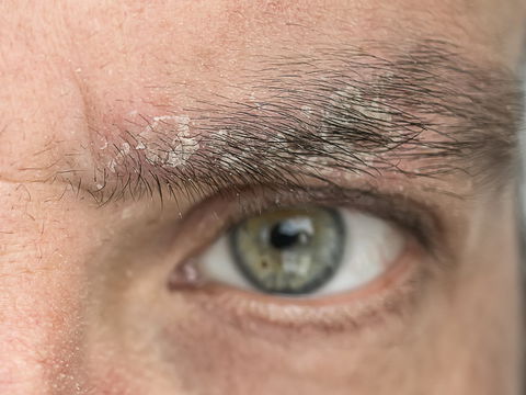 Was hilft gegen Schuppen in den Augenbrauen?