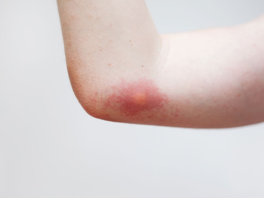 Wespenstich am Arm