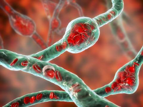 Aneurysma im Kopf geplatzt: So stehen die Überlebenschancen