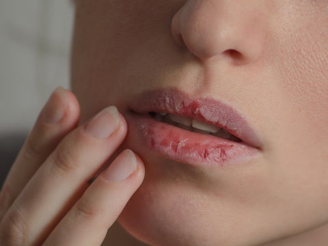 Aufgeplatzte Lippen: Die besten SOS-Tipps