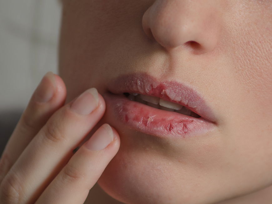 Frau fasst sich an ihre aufgeplatzten Lippen