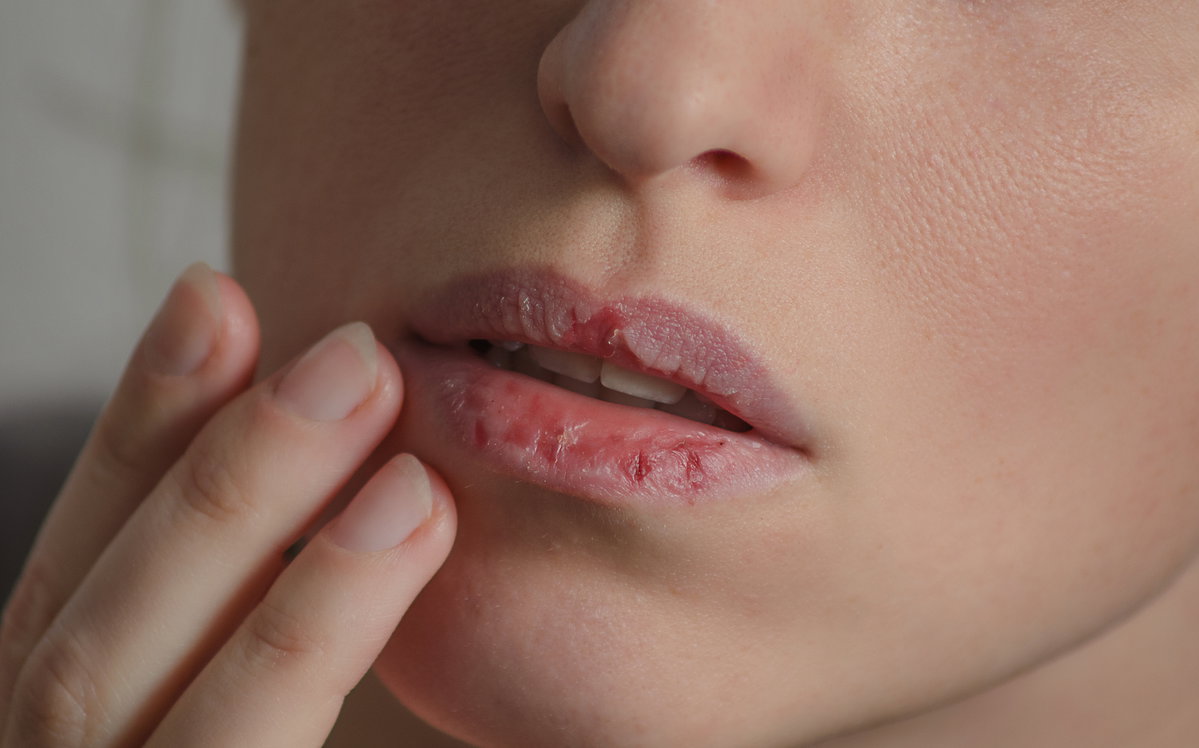 Frau fasst sich an ihre aufgeplatzten Lippen