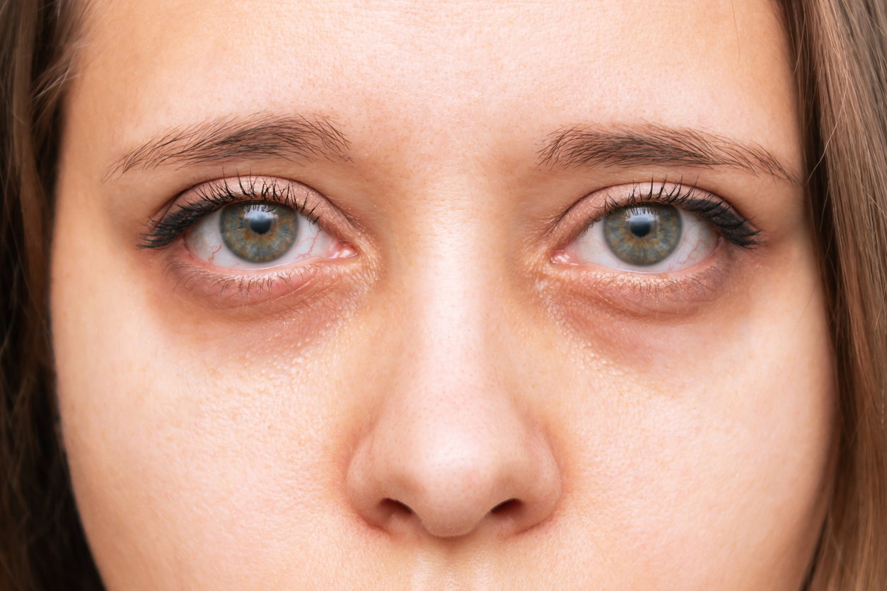 Eingefallene Augen: Das sind die Gründe und was Sie jetzt tun können