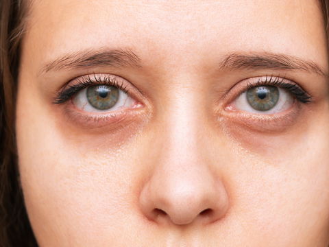 Eingefallene Augen: Das sind die Gründe und was Sie jetzt tun können