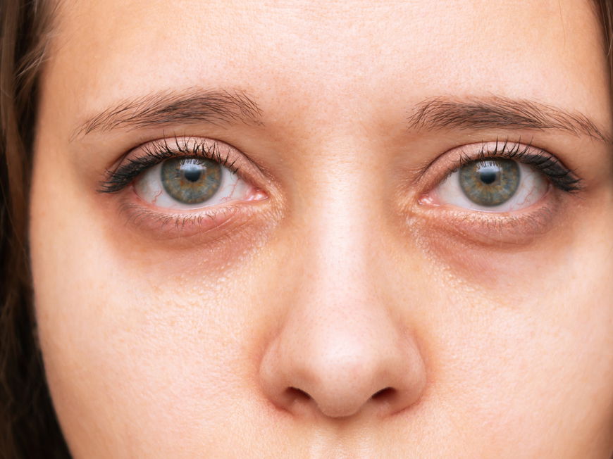 junge Frau mit eingefallenen Augen und dunklen Augenringen