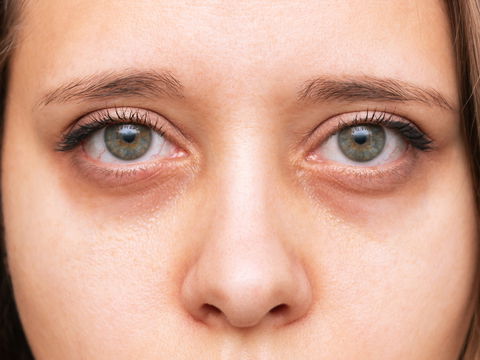 Eingefallene Augen: Das sind die Gründe und was Sie jetzt tun können