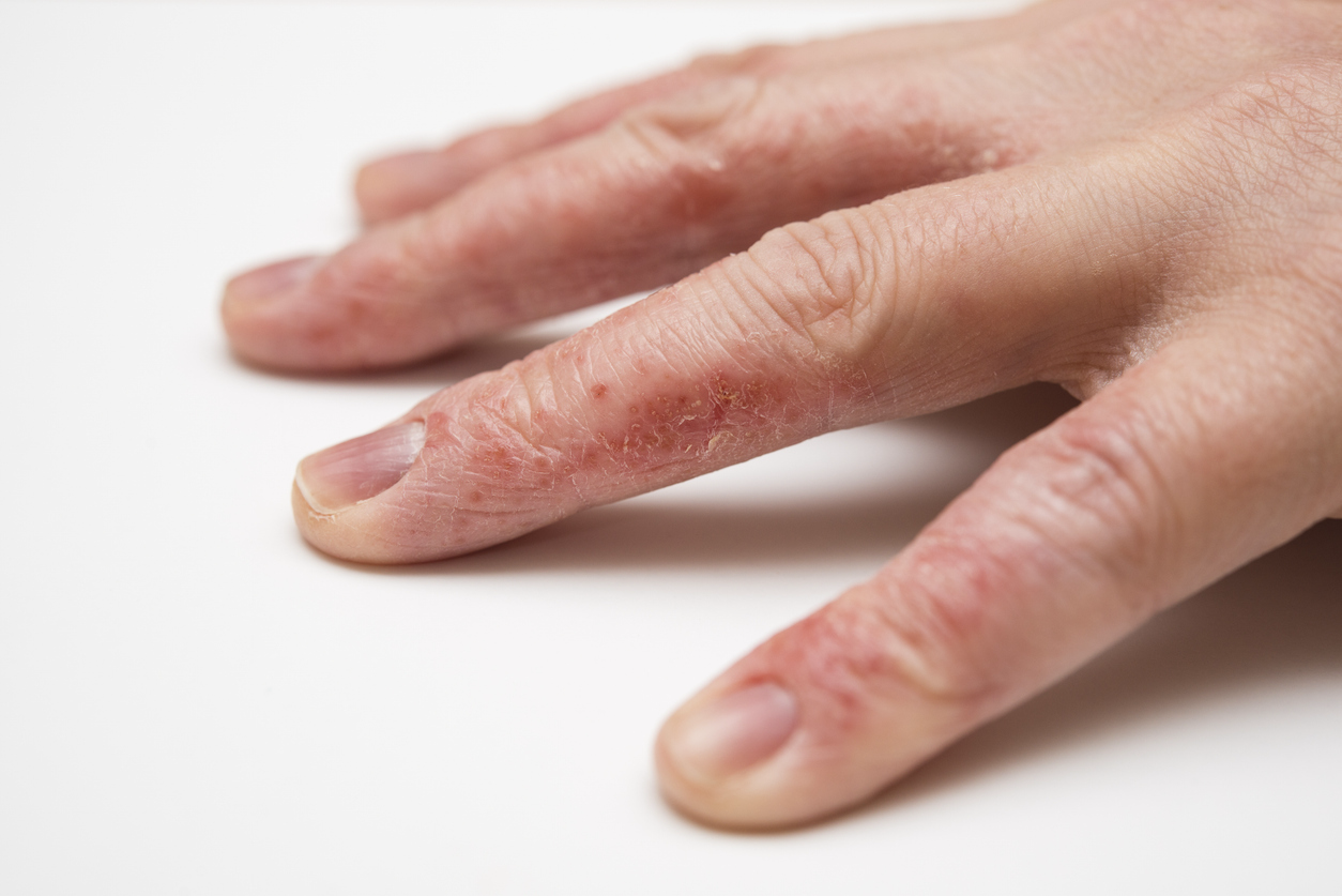 Fingerkuppen schälen sich: Die besten Tipps für geschmeidige Hände