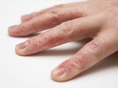 Fingerkuppen schälen sich: Die besten Tipps für geschmeidige Hände