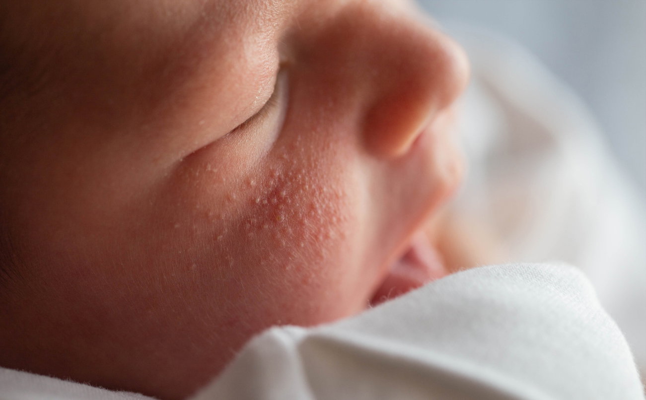 Hitzepickel bei Babys richtig erkennen und behandeln