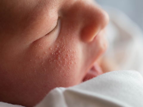 Hitzepickel bei Babys richtig erkennen und behandeln