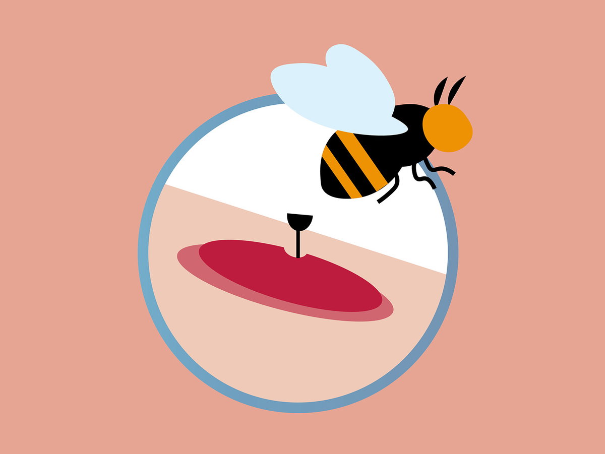 Darstellung eines Bienenstichs